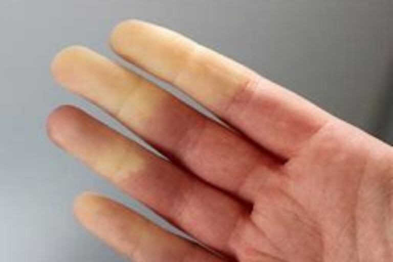 raynauds