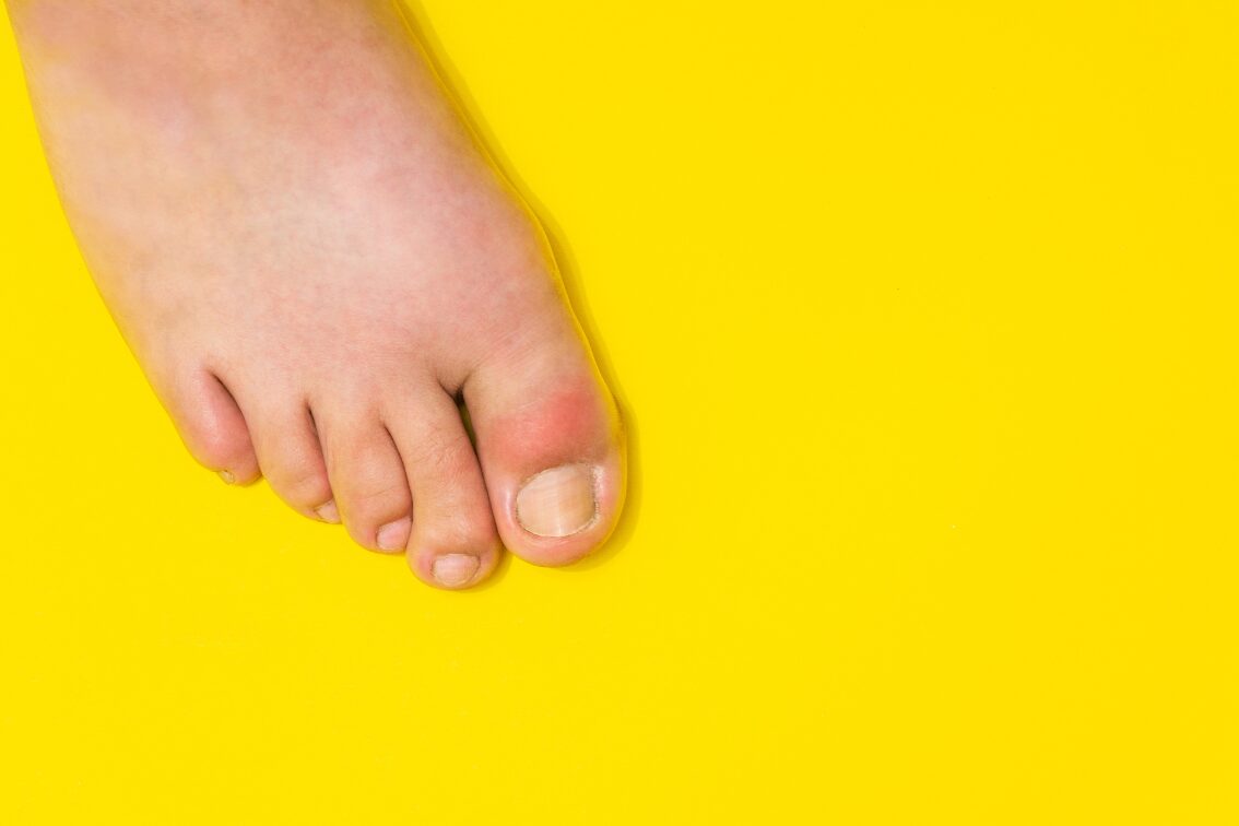 Gout toe pain relief